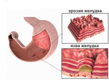 Dieta cu eroziune a stomacului pe care o puteți și nu o puteți mânca