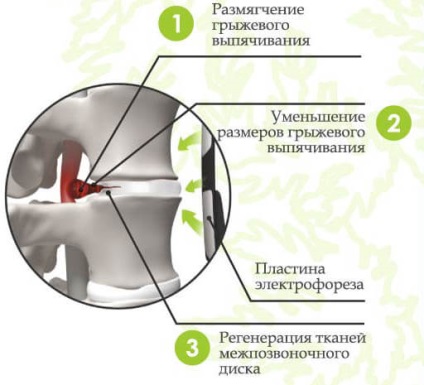 Електрофорез при грижі хребта (з Карипазиму) поперекової, шийної