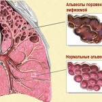 Emfizemul plămânilor este ceea ce este să vindeci o boală