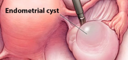 Chistul endometrioid al ovarului stâng (drept)