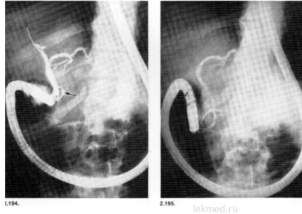 Endoscopie în diagnosticul diferențial - colelitiază - un ghid clinic