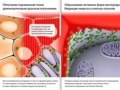 Terapia fotodinamică în Chelyabinsk - prețuri - centru medical 