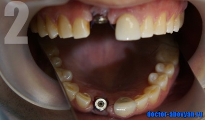 Fotografie a protezelor dentare înainte și după