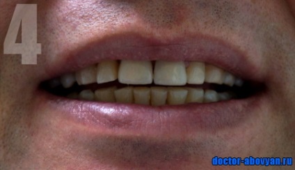 Fotografie a protezelor dentare înainte și după