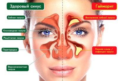 Sinusită simptome ale bolii și tratament