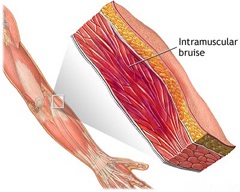 Hematomi - tratament, tipuri, simptome