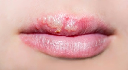 Herpes - remedii folclorice