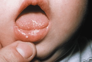 Herpesul în gura unui copil - simptome foto și tratamentul infecției