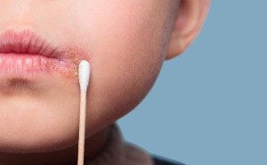 Herpesul în gura unui copil - simptome foto și tratamentul infecției