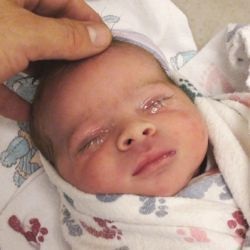 Gonoblennaya nou-nascuti - simptome, metode de tratament