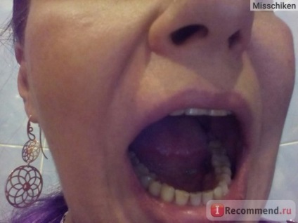 Implantarea dintelui - 