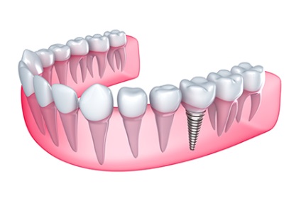 Implantarea dinților în ryazani în clinica de alfa-stomatologie, plasarea implantului