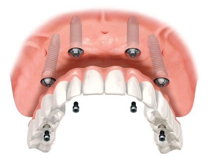 A fogak beültetése négy (állandó) 4-es protézisre