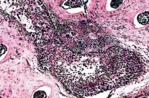 Az invazív emlőrák a malignus daganat kialakulásának egyik formája