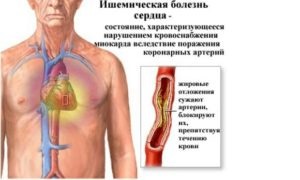 Ischemia - ce este și cât de periculoasă este boala din mijloc