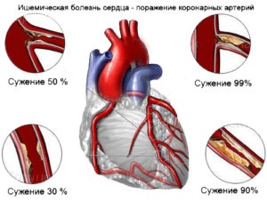 Ischemia - ce este și cât de periculoasă este boala din mijloc