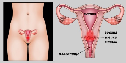 Cum să tratați eroziunea cervicală