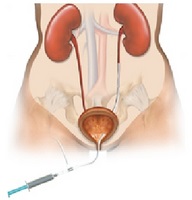 Cum pot reduce volumul prostatei?