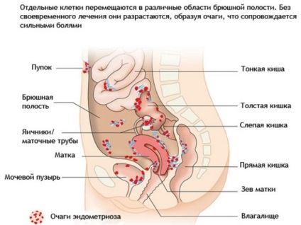 Hogyan lehet eltávolítani a fájdalmat az alsó hasban a menstruáció