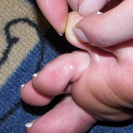 Cum de a vindeca porumbul între degetele de la picioare