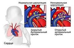Calcifierea valvei aortice