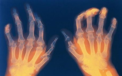 Canabisul împotriva artritei reumatoide, utilizarea canabisului