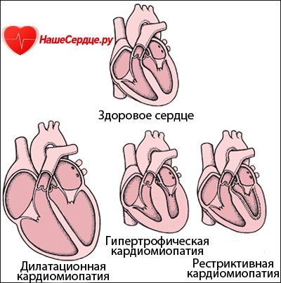 Cardiomiopatia clasificare, tratament, simptome