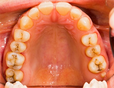 Carii dentare - simptome, cauze, fotografie