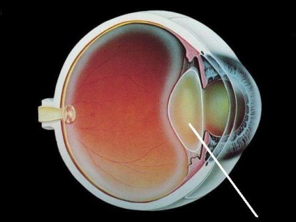 Tratamentul cu cataractă a remediilor populare fără intervenție chirurgicală, recenzii