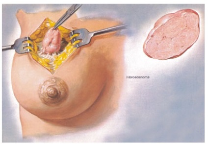 Tratamentul chistului mamar și prevenirea bolilor