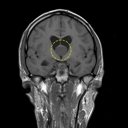 Chistul glandei pineale a creierului - tratamentul tumoral