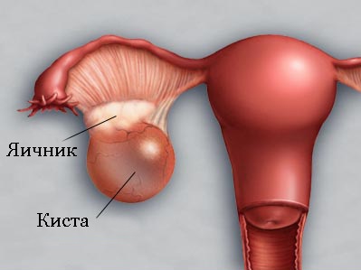 Chist simptomele genitale interne, semne, diagnostic și tratament