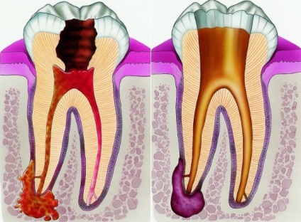 Chistul dintelui sub coroană provoacă apariția și particularitățile terapiei