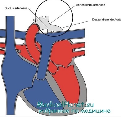 Coarctarea aortei