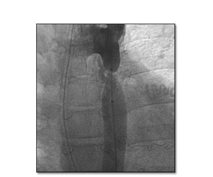 Coarctarea tratamentului aortei - medglobus medlobus