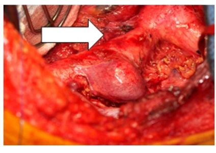 Coarctarea tratamentului aortei - medglobus medlobus