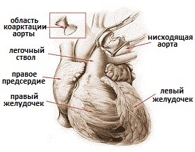Coarctarea informațiilor despre simptomele aortei