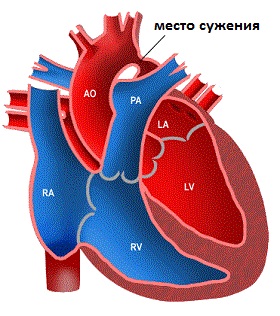 Coarctarea informațiilor despre simptomele aortei