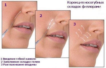 Корекция на назолабиални гънки пълнители ревюта, проценти и последствия