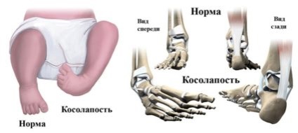 Kosolapov - вродени и придобити, симптоми и лечение
