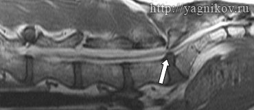 Sindromul lombar sacral la câini