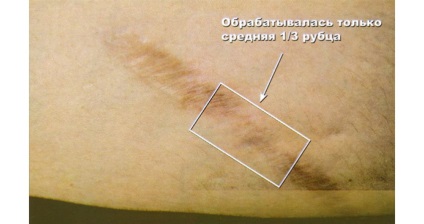 Laser fraxel în Novosibirsk prețurile, recenzii, fotografie înainte și după, eliminarea cicatricilor, vergeturi, vasculare