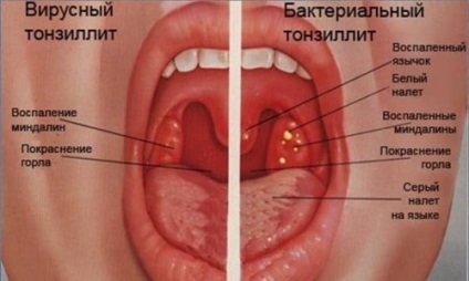 Tratamentul anginei la domiciliu tratament al anginei la copii, adulți, tratamentul durerii în gât cu antibiotice