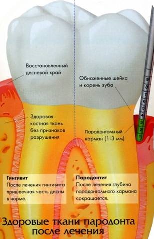 Tratamentul gingiilor în parodont în Moscova