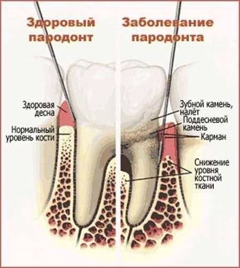 Tratamentul gingiilor în parodont în Moscova