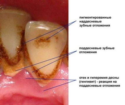 Tratamentul gingiilor în parodont în Moscova