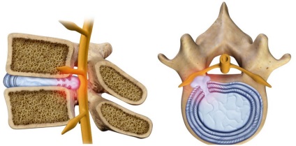 Tratamentul herniei coloanei vertebrale cervicale fără intervenție chirurgicală prin remedii folclorice, preparate