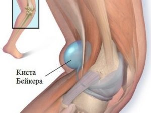 Tratamentul unui chist al motociclistului prin remedii populare