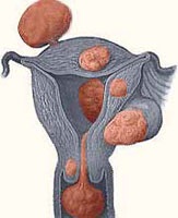 Tratamentul fibromului uterin - articole, știri