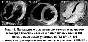 Imagistica prin rezonanță magnetică și capacitățile sale de diagnosticare în cardiologie